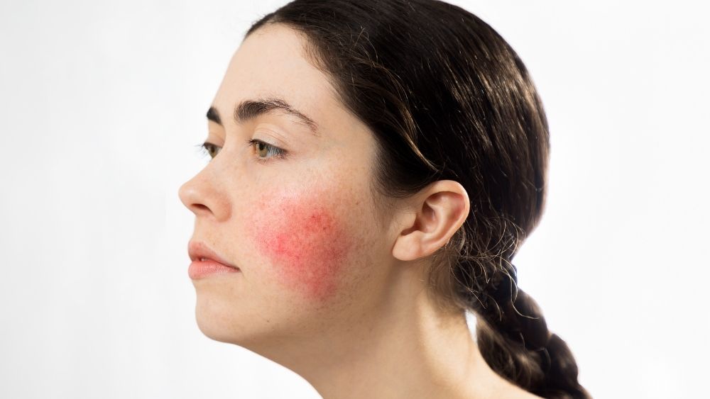 Rosacea